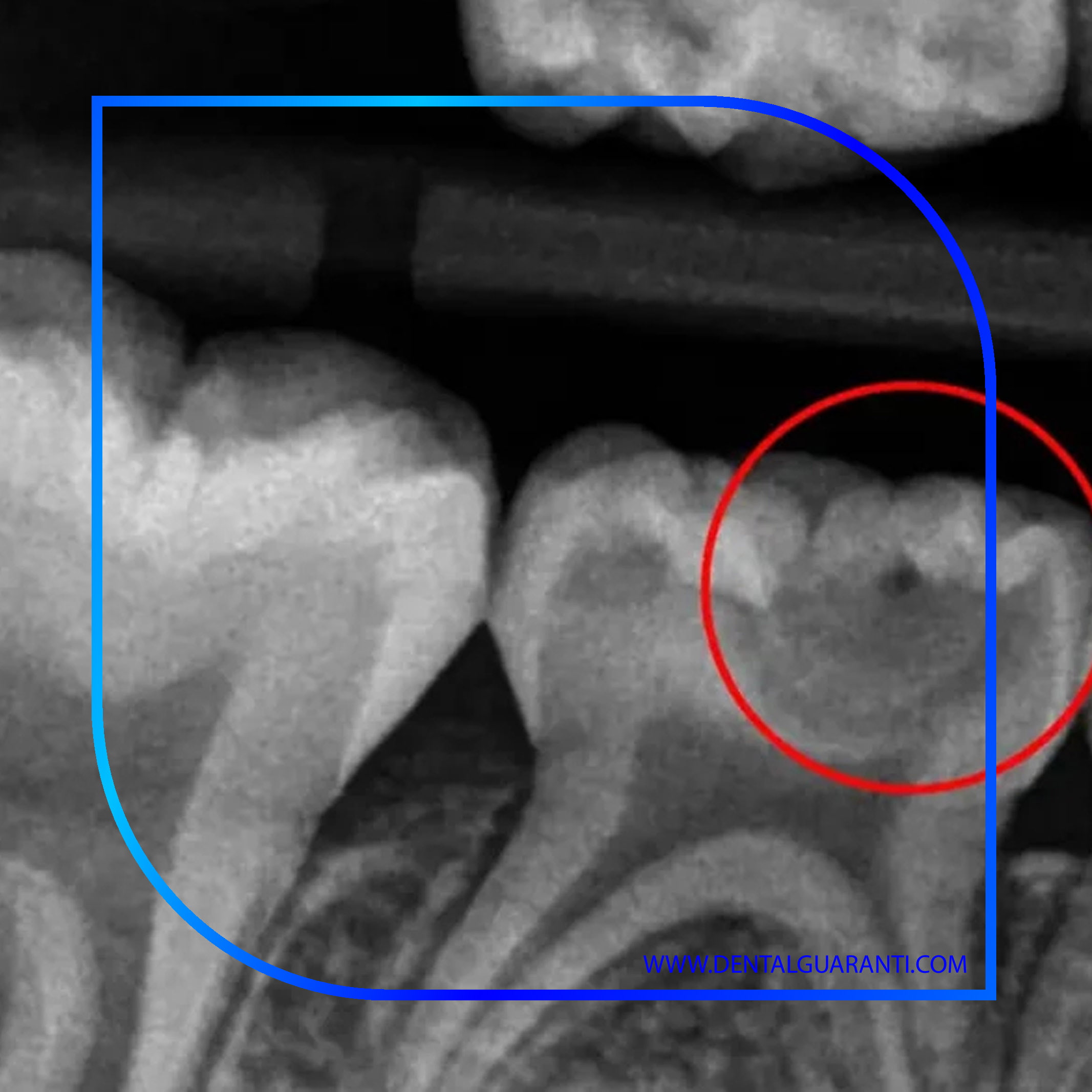نقش فناوری‌های تصویربرداری دیجیتال در تشخیص اولیه پوسیدگی