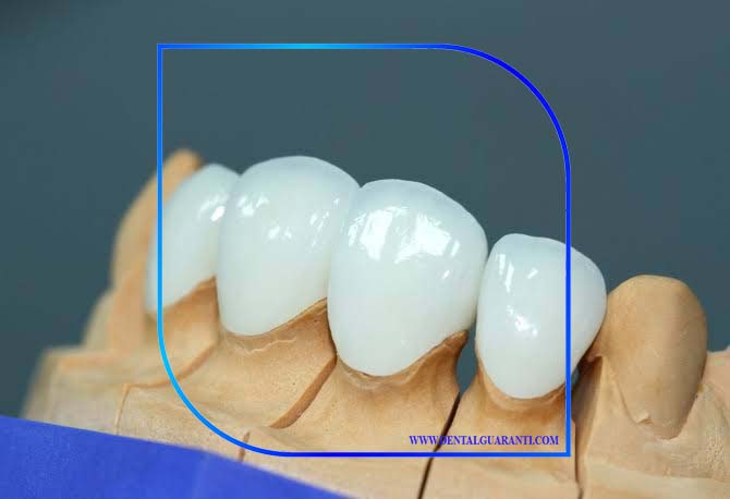 اشتباه استفاده از مواد ترمیمی دندان-1