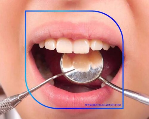 انواع آینه دندانپرشکی-1 - Copy