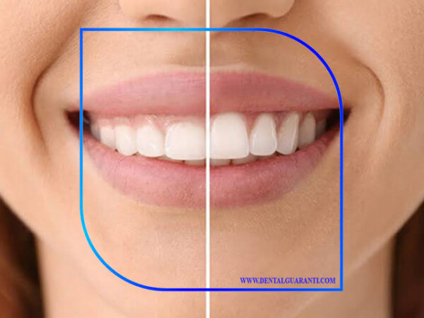 لبخند لثه ای یا گامی اسمایل-6